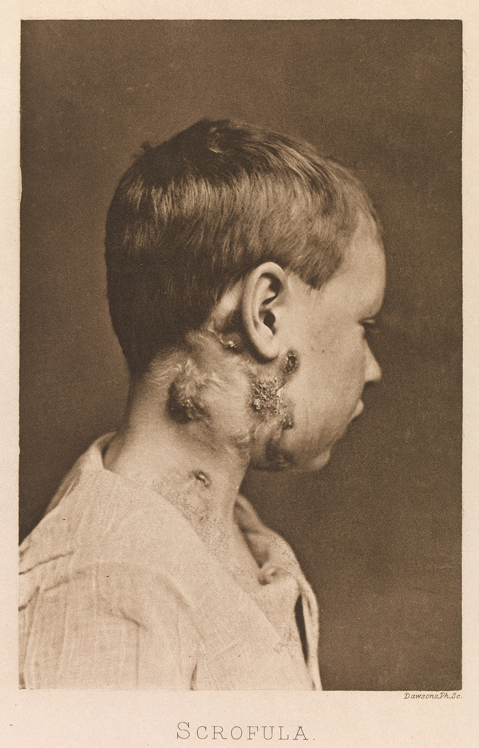 Scrofulous enlargement of the cervical and axillary glands. From Bramwell, 1892.